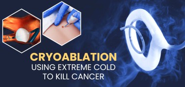 कैंसर को मारने के लिए बहुत ज्यादा ठंड का इस्तेमाल